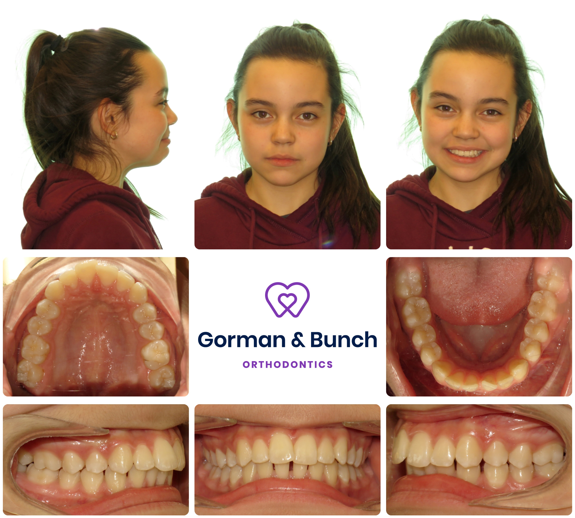 invisalign before and after - overbite - carmel indiana - fnv - 1